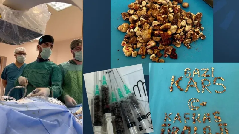 300 Böbrek Taşı Şoku! Hatıra Diye Evine Götürdü!